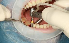 Dental Implants vs. Traditional Tooth Replacements