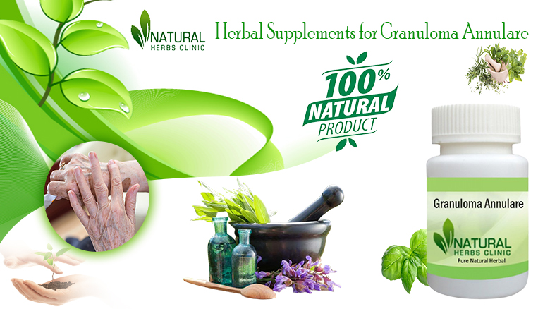 Herbal Supplements For Granuloma Annulare