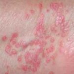 How Herbal Remedies Can Soothe Lichen Planus Symptoms Naturally