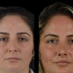 cheek fillers in dubai