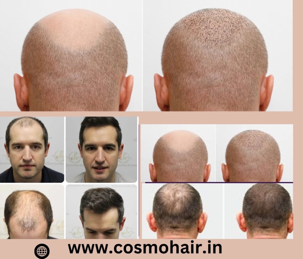 Best Hair Doctor in Chandigarh