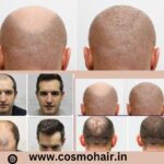 Best Hair Doctor in Chandigarh