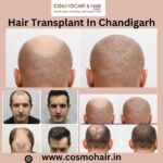 Hair Transplant In Chandigarh