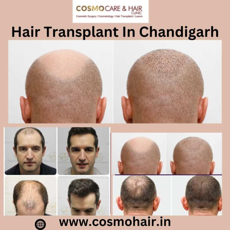 Hair Transplant In Chandigarh