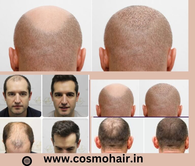 Best Hair Doctor in Chandigarh