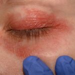 eyelid psoriasis differences