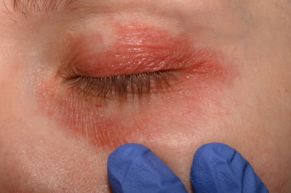 eyelid psoriasis differences