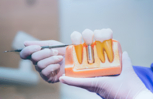 implant dentistry spanish fort al