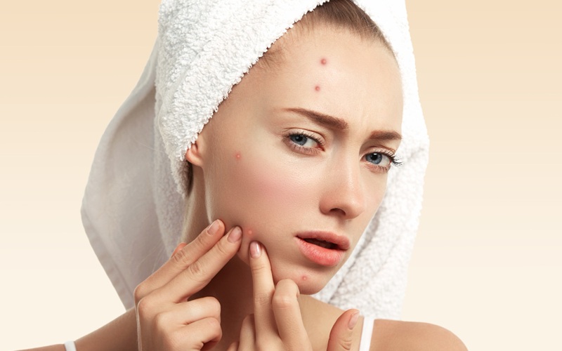 Woman with pimples using pimple clear face wash