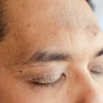 psoriasis clinical trial research