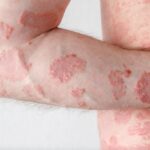 understanding contact dermatitis