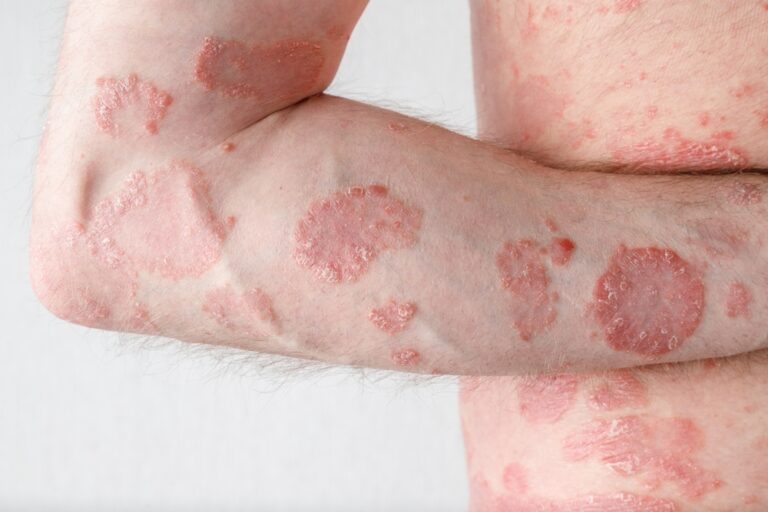 understanding contact dermatitis