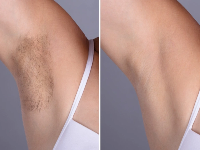 H15-Laser-Hair-Removal