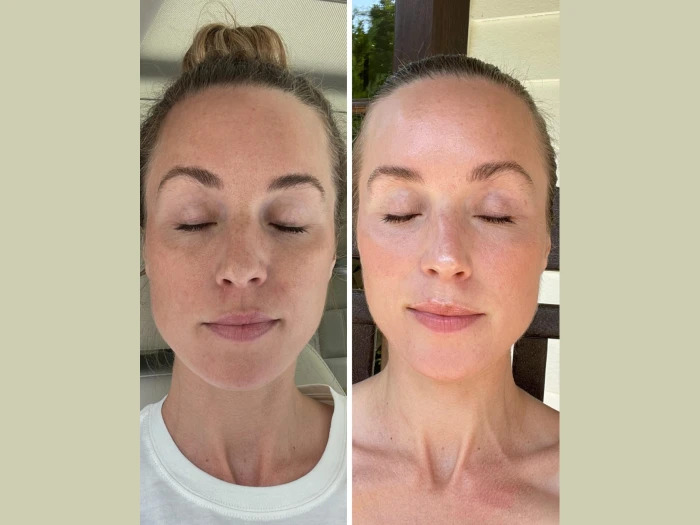 Fotona 4D Laser in Dubai