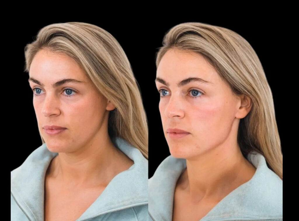 cheek fillers in duabai