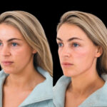 cheek fillers in duabai