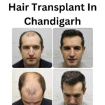 Best Hair Transplant in Chandigarh