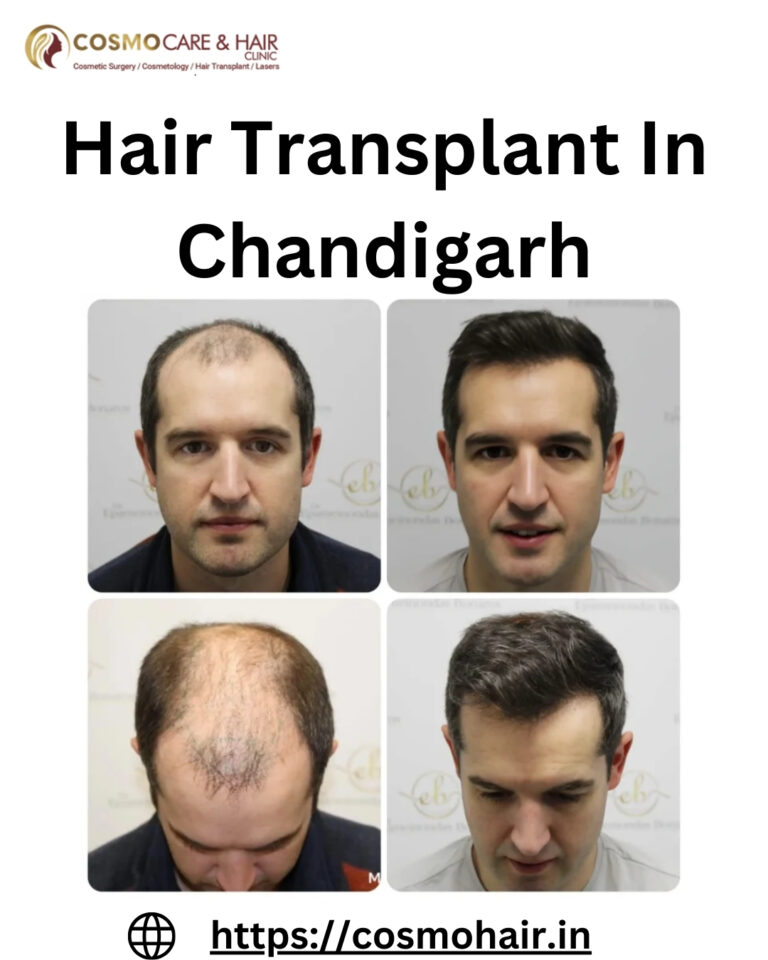 Best Hair Transplant in Chandigarh