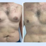 Gynecomastia Surgery in Dubai