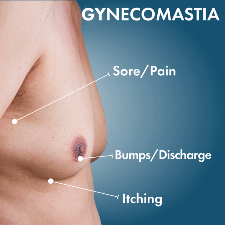 gynecomastia in islamabad