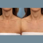 Moxi Laser Therapy in Dubai