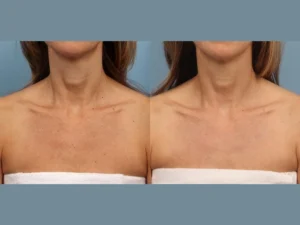 Moxi Laser Therapy in Dubai