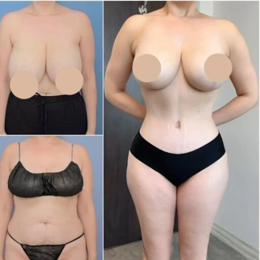 tummy tuck