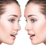 Rhinoplasty in Dubai