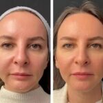 Mesotherapie in Dubai