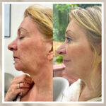 Rosacea In Manchester