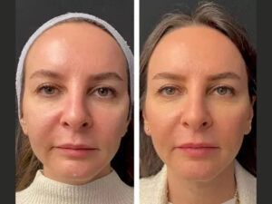 Mesotherapie in Dubai