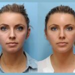 Best Aesthetic Clinics in Dubai Perfects Thread Lift Solutions for Refreshed Tighter Skin Appearance