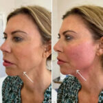 Endolift for Face Contouring at the Best Aesthetic Clinic in dubai