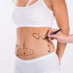 Liposuction in Dubai