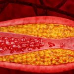 Hyperlipidemia-_-High-Cholesterol