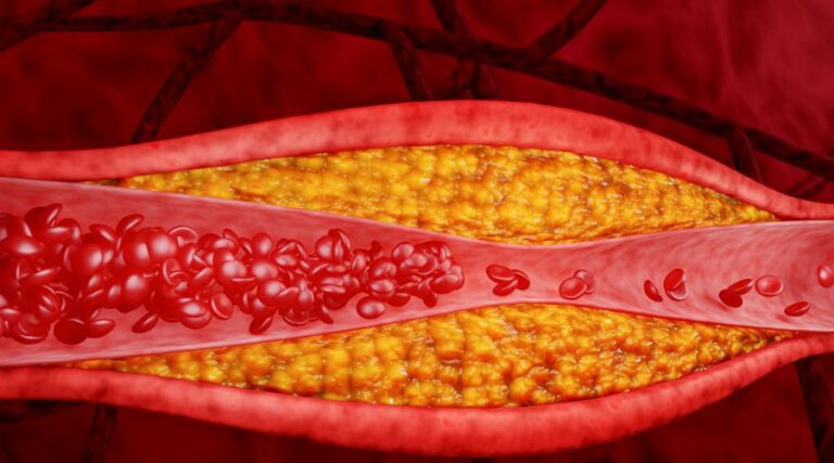 Hyperlipidemia-_-High-Cholesterol