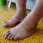 Non-Diabetic Foot Ulcer