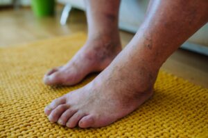 Non-Diabetic Foot Ulcer