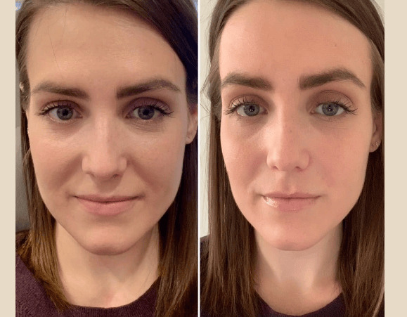 Prp Treatment in dubai