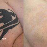 Tattoo Removal in London