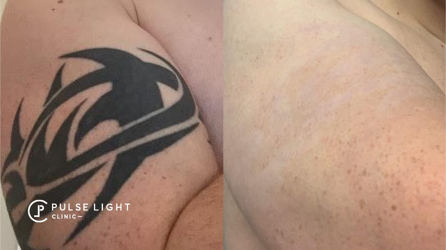 Tattoo Removal in London