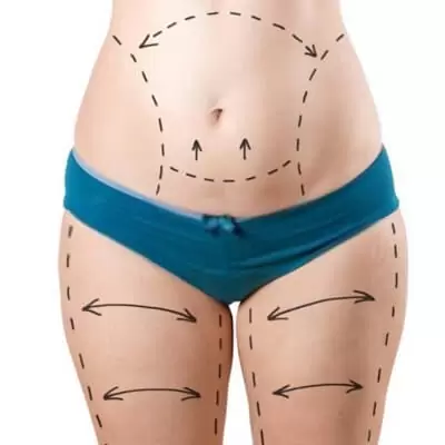Tummy Tuck