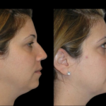 Double chin removal in Dubai