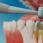 root canal treatment in Islamabad