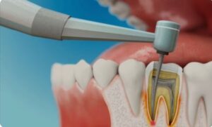 root canal treatment in Islamabad
