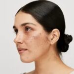 melasma treatment in Islamabad