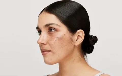 melasma treatment in Islamabad