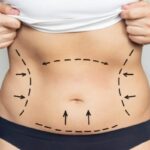 Liposuction in Dubai