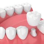 Disadvantages of Dental Crowns