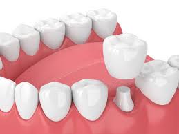 Disadvantages of Dental Crowns
